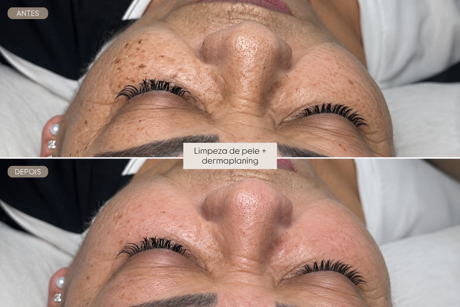 Comparação antes e depois de limpeza de pele e dermaplaning realizada no salão